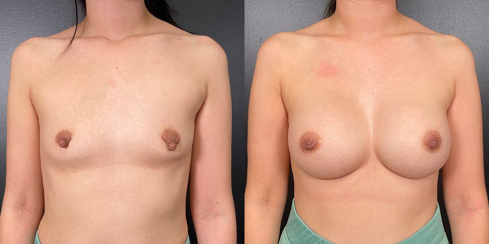 Breast Augmentation Before & After Gallery - Patient 146804265 - Image 1