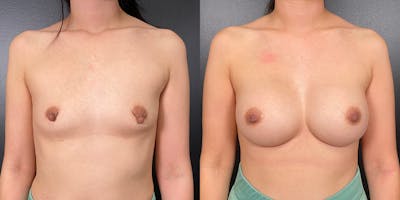 Breast Augmentation Before & After Gallery - Patient 146804265 - Image 1