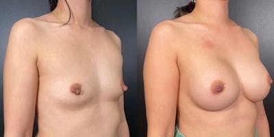 Breast Augmentation Before & After Gallery - Patient 146804265 - Image 2