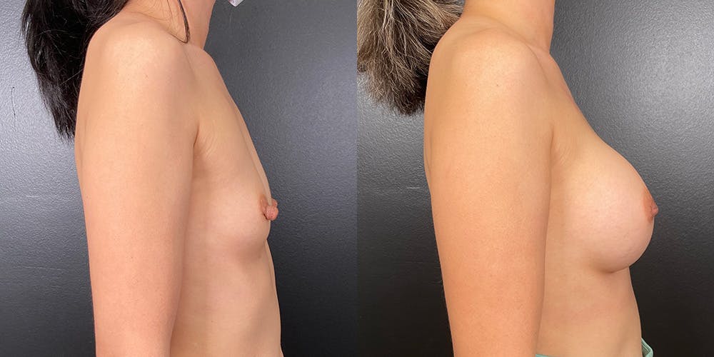 Breast Augmentation Before & After Gallery - Patient 146804265 - Image 3