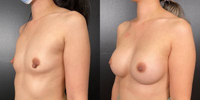 Breast Augmentation Before & After Gallery - Patient 146804265 - Image 4