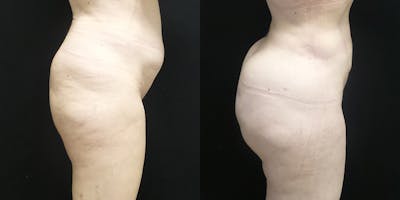 Brazilian Butt Lift Before & After Gallery - Patient 147537529 - Image 2