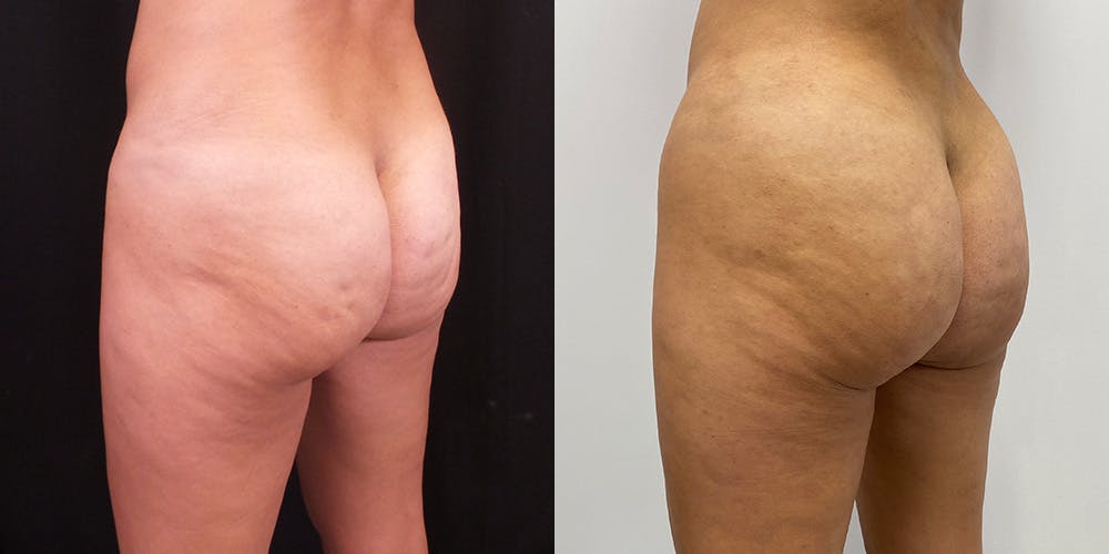 Brazilian Butt Lift Before & After Gallery - Patient 147537530 - Image 1