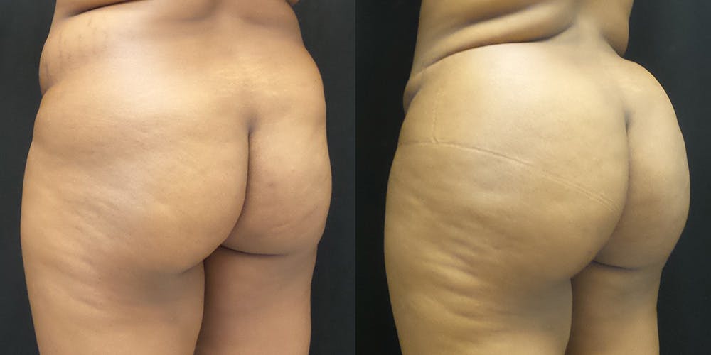 Brazilian Butt Lift Before & After Gallery - Patient 147537593 - Image 1