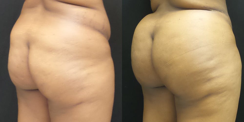 Brazilian Butt Lift Before & After Gallery - Patient 147537593 - Image 2