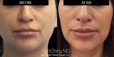 Lip Lift Before & After Gallery - Patient 147694929 - Image 1