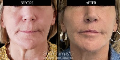 Lip Lift Before & After Gallery - Patient 147616507 - Image 1