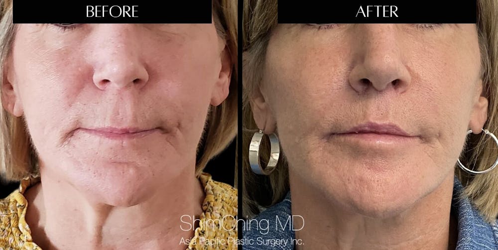 Lip Lift Before & After Gallery - Patient 147616507 - Image 1