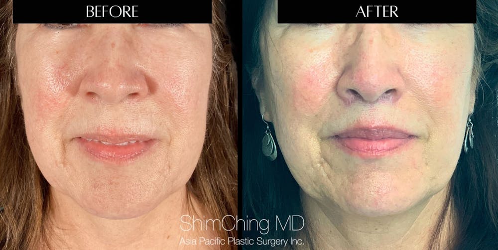 Lip Lift Before & After Gallery - Patient 147616518 - Image 1