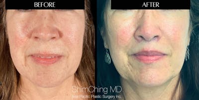 Lip Lift Before & After Gallery - Patient 147616518 - Image 1