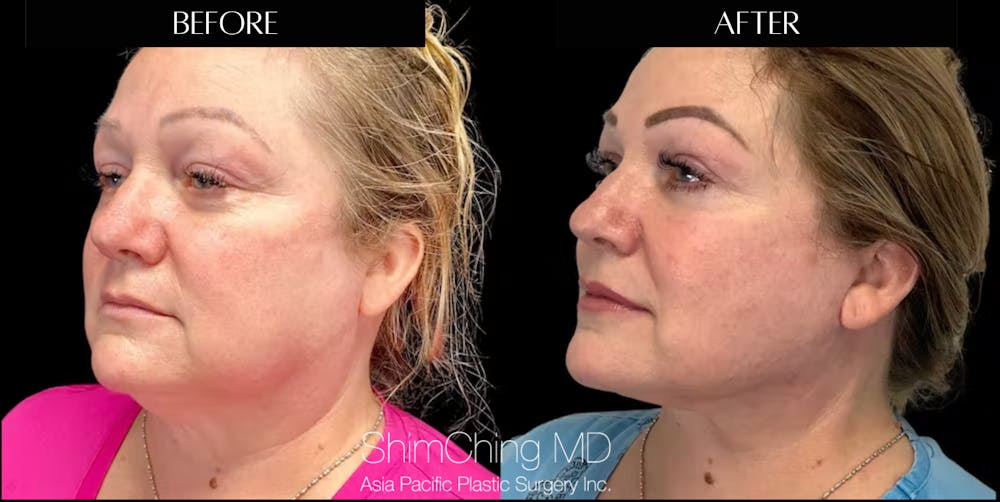 Lip Lift Before & After Gallery - Patient 147616508 - Image 1