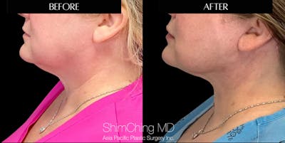 Lip Lift Before & After Gallery - Patient 147616508 - Image 2