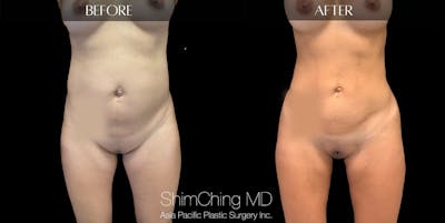 Brazilian Butt Lift Before & After Gallery - Patient 147720500 - Image 4