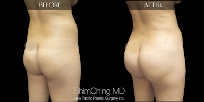 Brazilian Butt Lift Before & After Gallery - Patient 147720517 - Image 1
