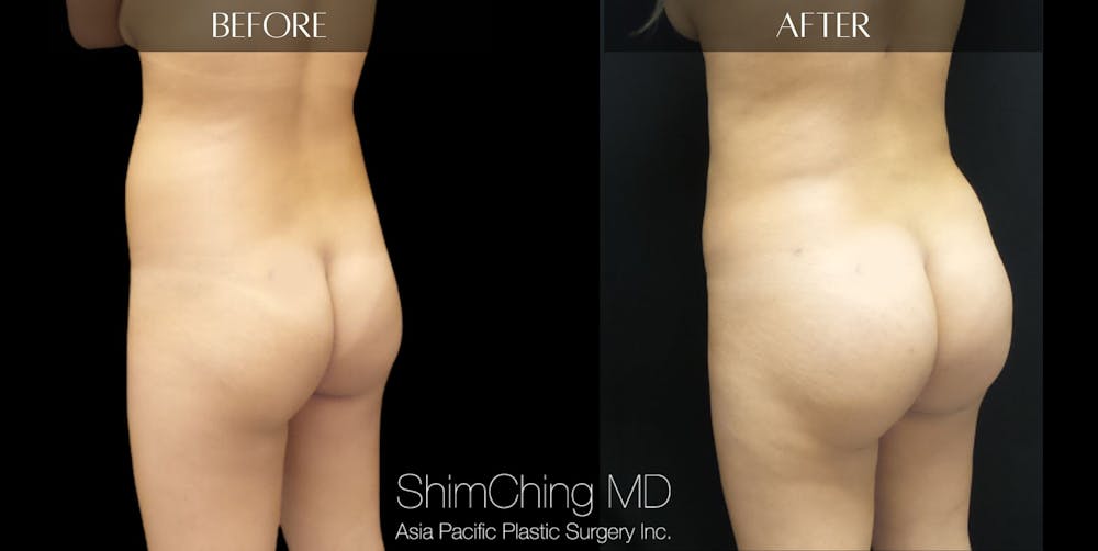 Brazilian Butt Lift Before & After Gallery - Patient 147720517 - Image 3