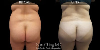 Brazilian Butt Lift Before & After Gallery - Patient 147720553 - Image 2