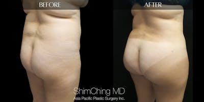 Brazilian Butt Lift Before & After Gallery - Patient 147720553 - Image 1