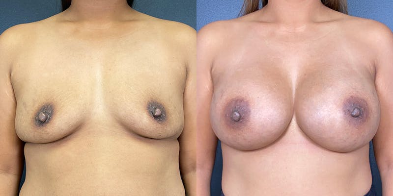 Before and after Breast Augmentation in Honolulu with Dr. Shim Ching