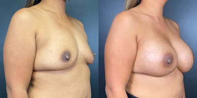 Breast Augmentation Before & After Gallery - Patient 147721395 - Image 2