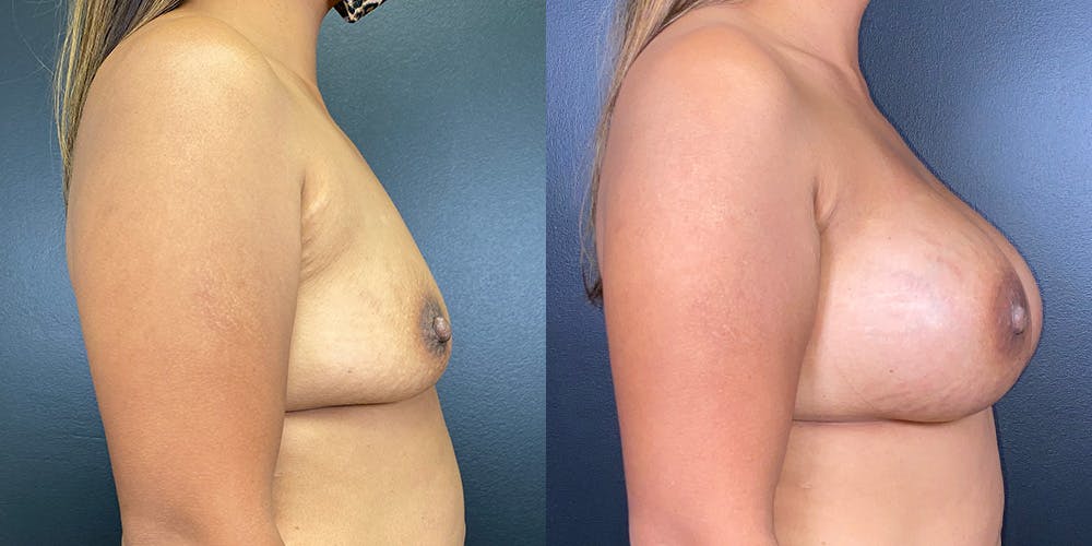 Breast Augmentation Before & After Gallery - Patient 147721395 - Image 3
