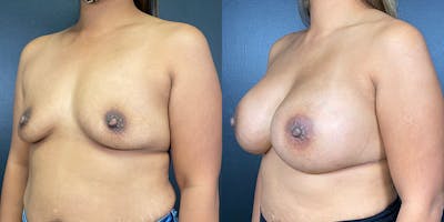 Breast Augmentation Before & After Gallery - Patient 147721395 - Image 4