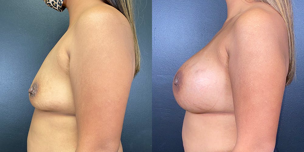 Breast Augmentation Before & After Gallery - Patient 147721395 - Image 5