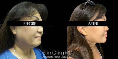 Facelift Before & After Gallery - Patient 147721540 - Image 1
