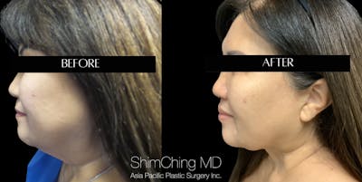 Facelift Before & After Gallery - Patient 147721540 - Image 2