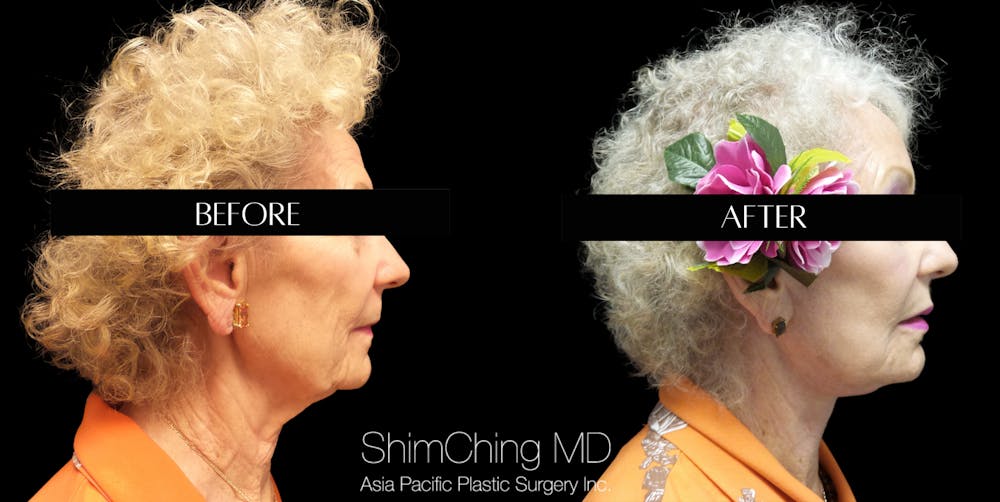 Facelift Before & After Gallery - Patient 147721555 - Image 4