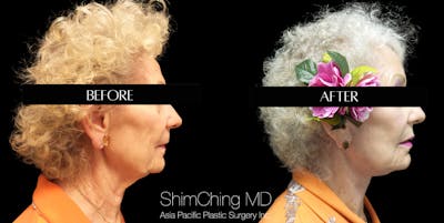 Necklift Before & After Gallery - Patient 147721409 - Image 2