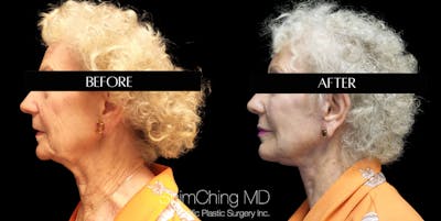 Neck Lift Before & After Gallery - Patient 147721409 - Image 1