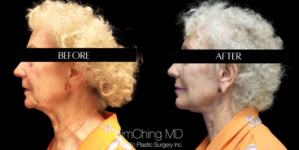 Facelift Before & After Gallery - Patient 147721555 - Image 3