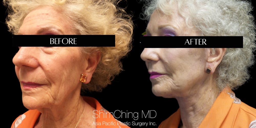 Facelift Before & After Gallery - Patient 147721555 - Image 2