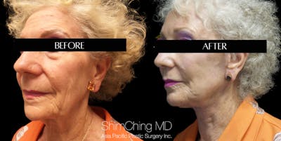 Facelift Before & After Gallery - Patient 147721555 - Image 2