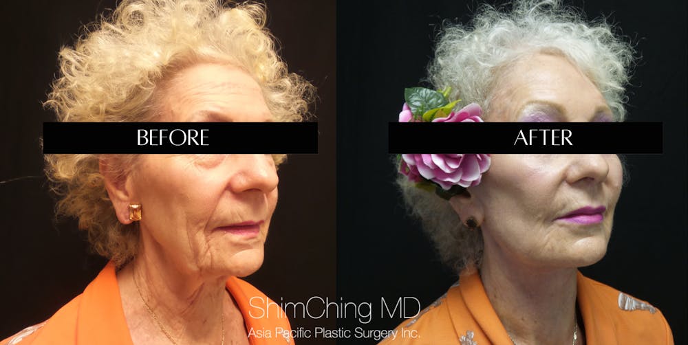 Facelift Before & After Gallery - Patient 147721555 - Image 1