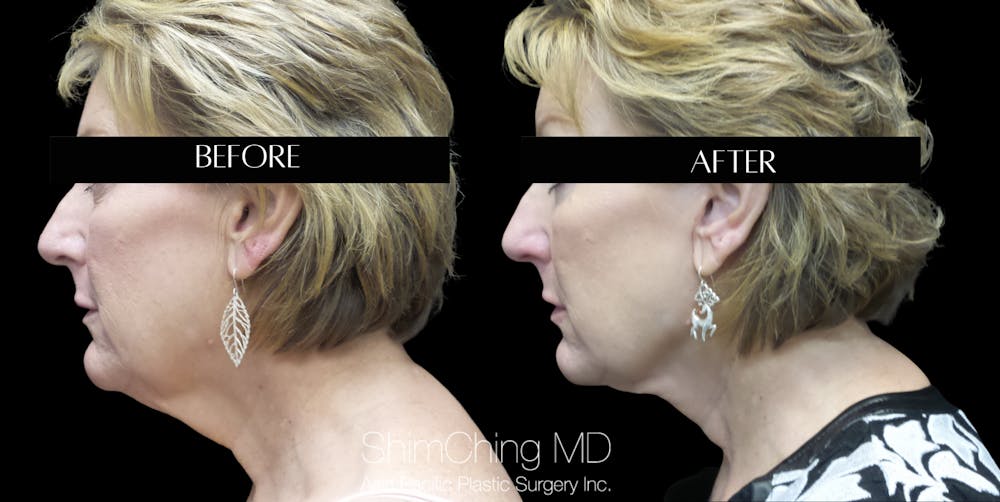 Necklift Before & After Gallery - Patient 147721411 - Image 1
