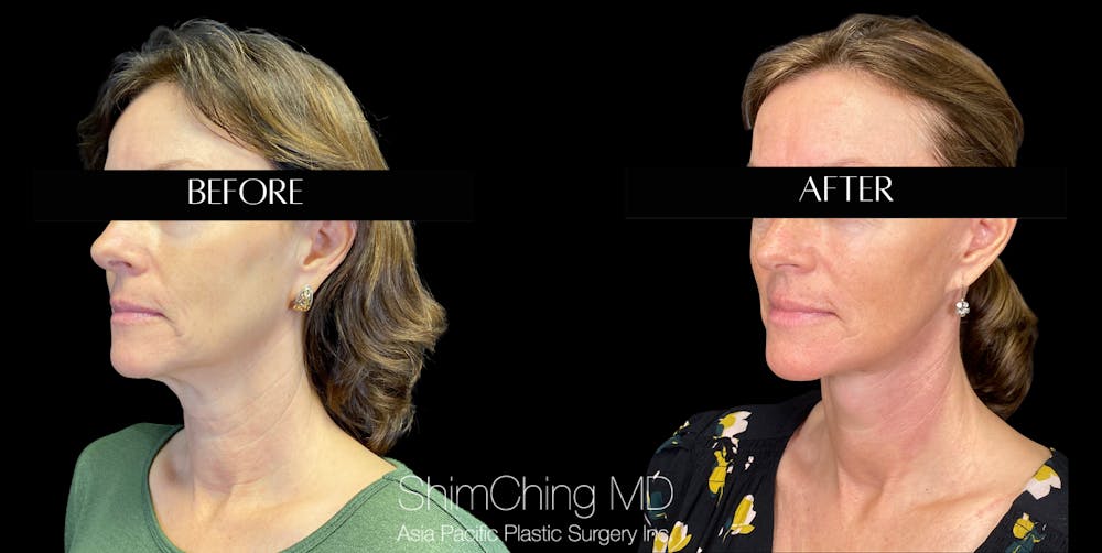 Necklift Before & After Gallery - Patient 147721569 - Image 1