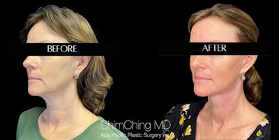 Necklift Before & After Gallery - Patient 147721569 - Image 1
