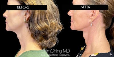 Necklift Before & After Gallery - Patient 147721569 - Image 4