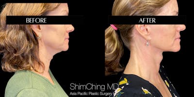 Neck Lift Before & After Gallery - Patient 147721569 - Image 4