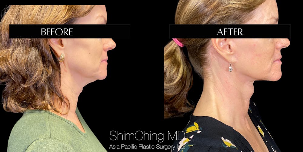 Necklift Before & After Gallery - Patient 147721569 - Image 3
