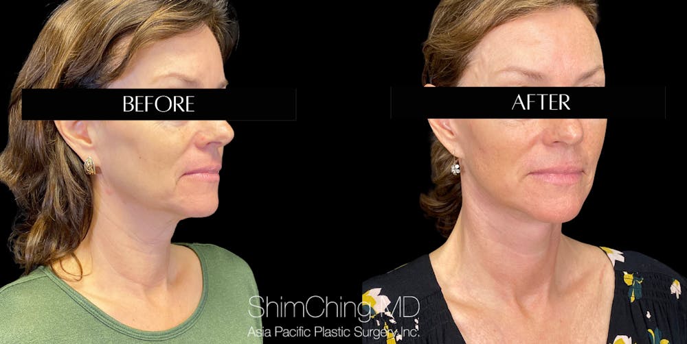 Necklift Before & After Gallery - Patient 147721569 - Image 2