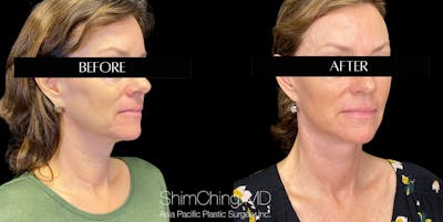 Necklift Before & After Gallery - Patient 147721569 - Image 2