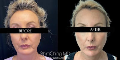 Facelift Before & After Gallery - Patient 147721602 - Image 1