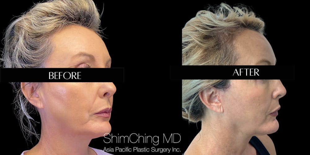 Facelift Before & After Gallery - Patient 147721602 - Image 2