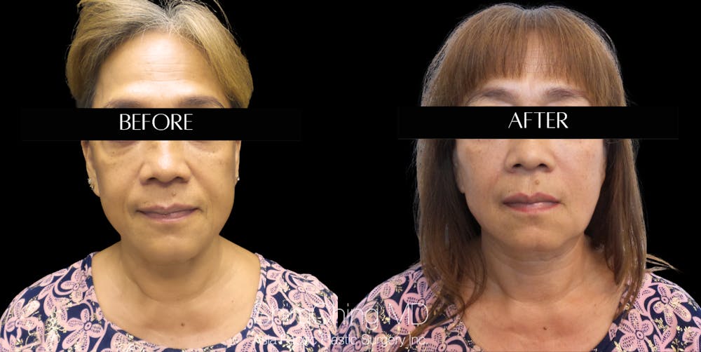 Facelift Before & After Gallery - Patient 147721620 - Image 1