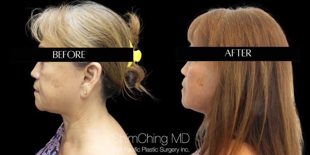 Facelift Before & After Gallery - Patient 147721620 - Image 2