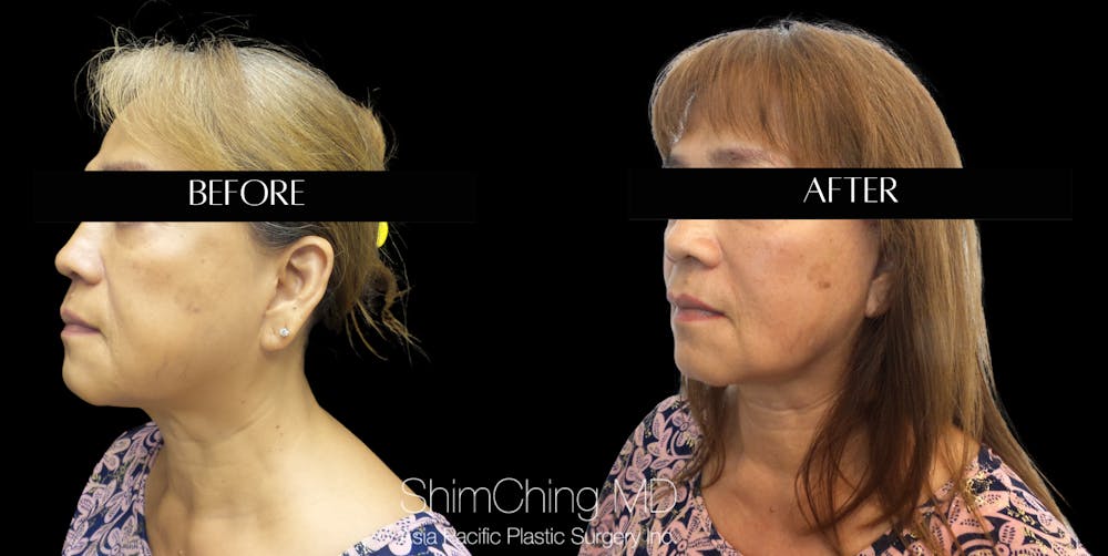 Facelift Before & After Gallery - Patient 147721620 - Image 3