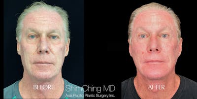 Facelift Before & After Gallery - Patient 147721628 - Image 1