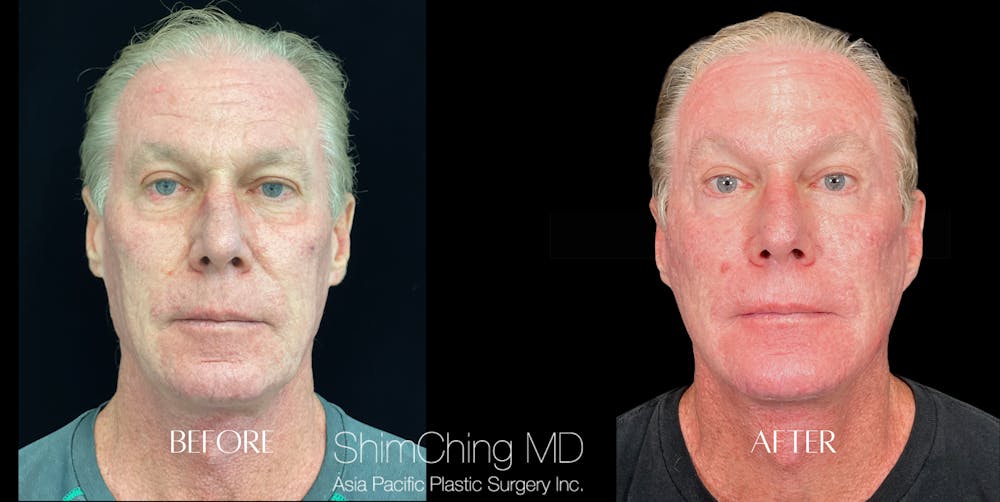 Facelift Before & After Gallery - Patient 147721628 - Image 1